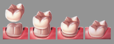 dental bangkok, dental clinic bangkok, dental bridges, dental crown, invisalign, dental treatment, dental veneers, dentist bangkok