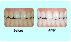 laser whitening bangkok, dental bangkok, dental clinic bangkok, dental bridges, dental treatment, dental veneers, dentist bangkok